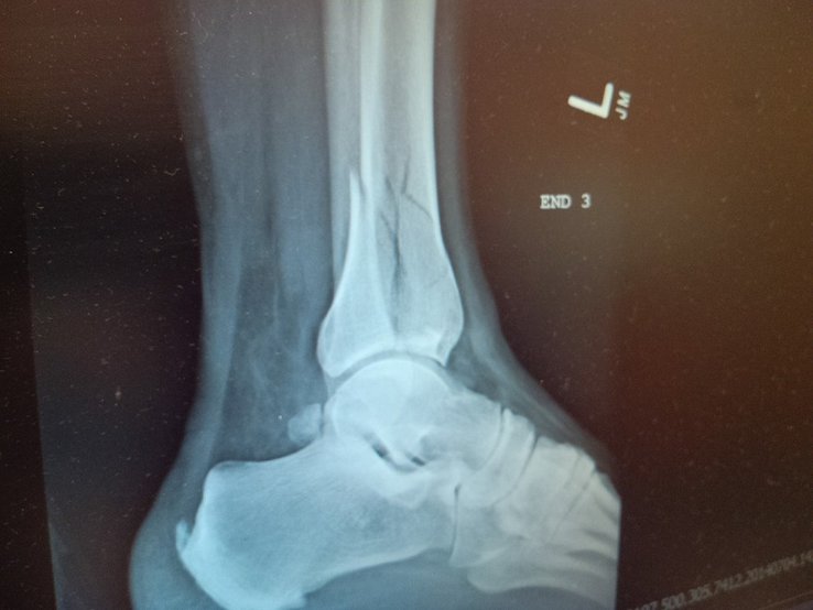 ankle1.jpg